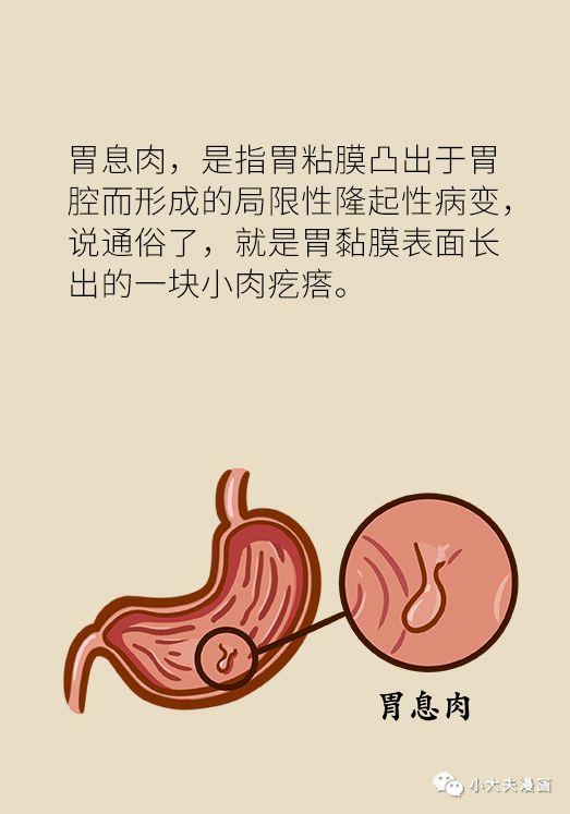 怎样防止胃息肉演变成胃癌(胃息肉是不是胃癌先兆)(7)