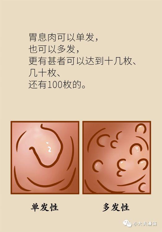 怎样防止胃息肉演变成胃癌(胃息肉是不是胃癌先兆)(8)